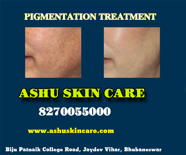 best pigmentation treatment clinic in bhubaneswar close to kims hospital